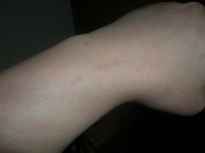 A scar on my wrist from puppy claws.